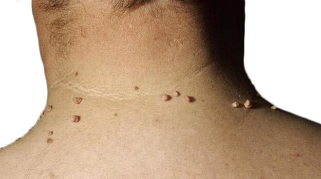 Papillomas of the neck - a consequence of the defeat of the virus