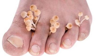 The reasons for the development of fungi between the toes