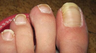 How nail fungus is manifested