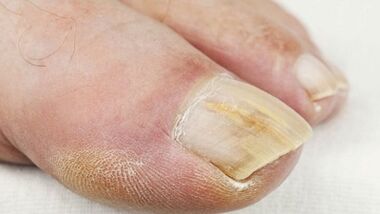 The initial stage of the development of nail fungus
