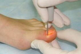 mechanical removal of the nail in case of fungal infection