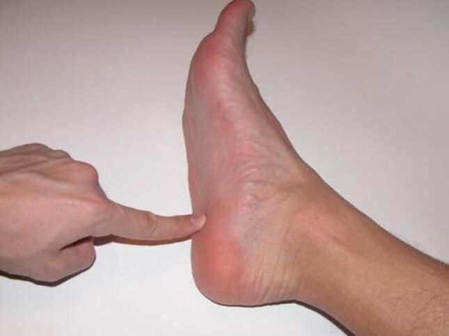 foot pain due to nail fungus