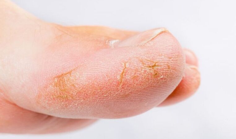 symptoms of fungus on the skin of the feet