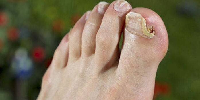 fungus on the nails of the big toe