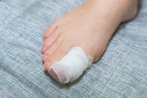 Apple Cider Vinegar Lotion Against Nail Fungus