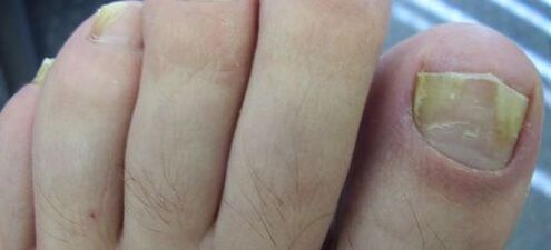symptoms of nail fungus and its treatment with vinegar