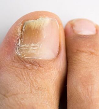 Fungus on the nails of the big toe, which appear against the background of weak immunity