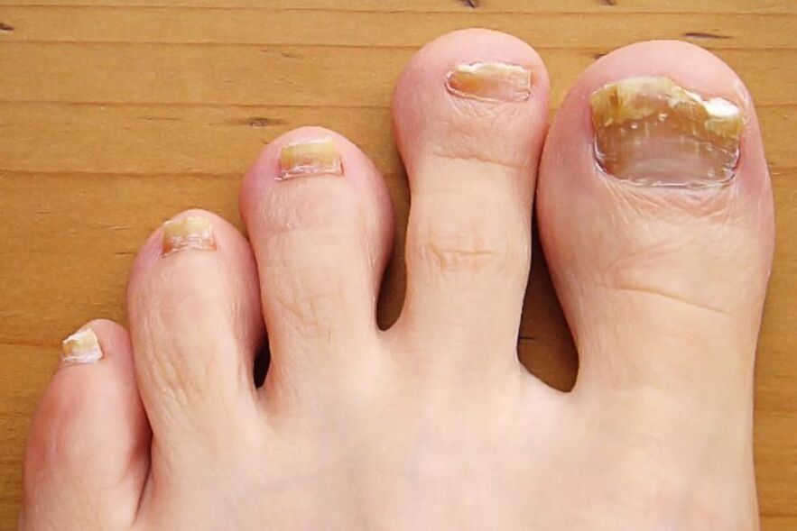 nail fungus symptoms