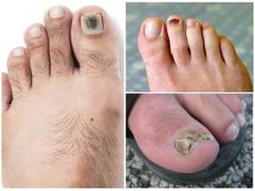 Signs of a toenail fungus infection