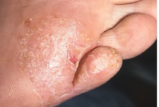 Manifestations of a fungal infection on the skin of the feet