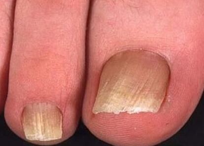 Foot fungus at the initial stage