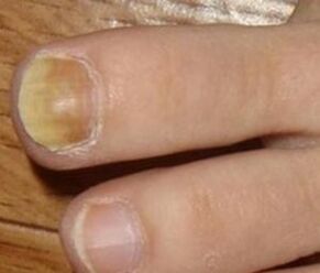 Symptoms of the initial stage of the nail fungus
